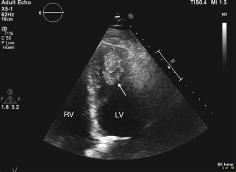 left ventricular mural thrombus treatment